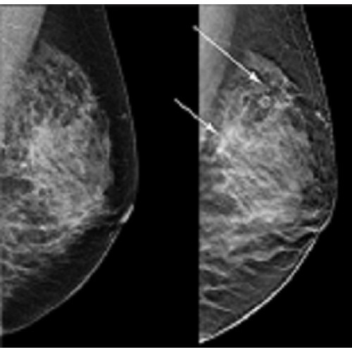 Digital tomosynthesis breast